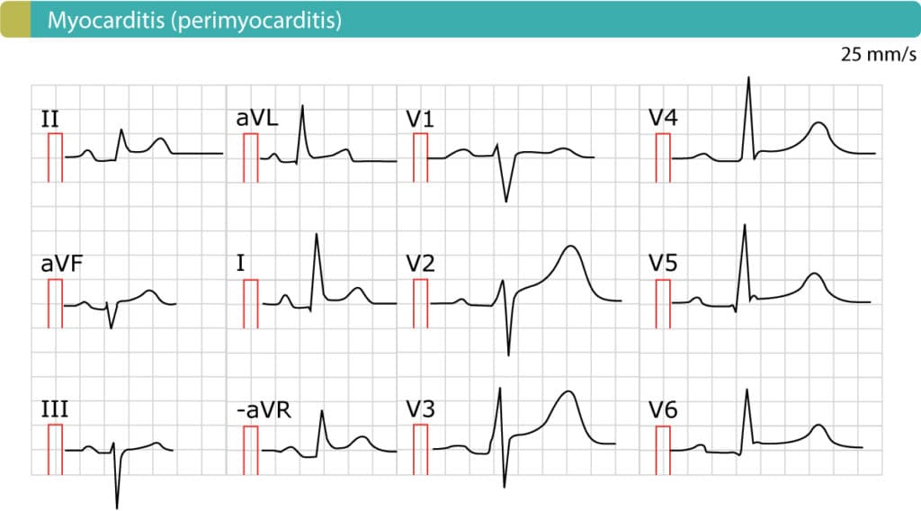 Figure 8. Perimyocarditis (myocarditis) causes generalized ST-segment elevations.